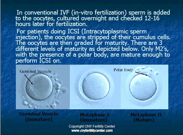 Icsi vs ivf illustration