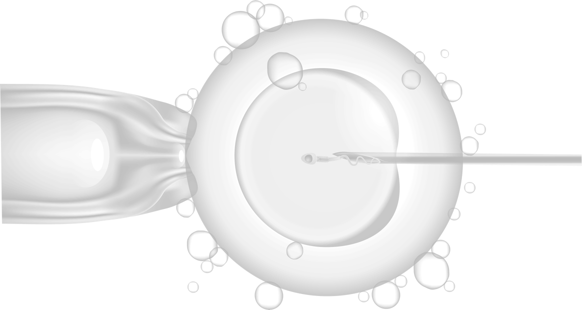 ICSI: What is ICSI IVF?