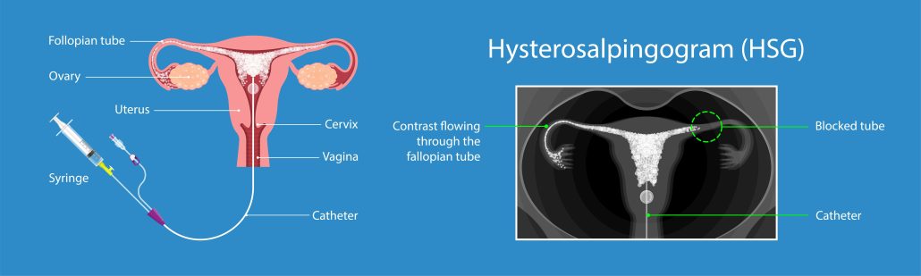 diagram of an Hysterosalpingogram