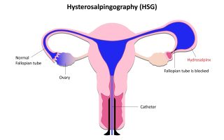What is a Hysterosalpingogram (HSG)? Uses and Benefits