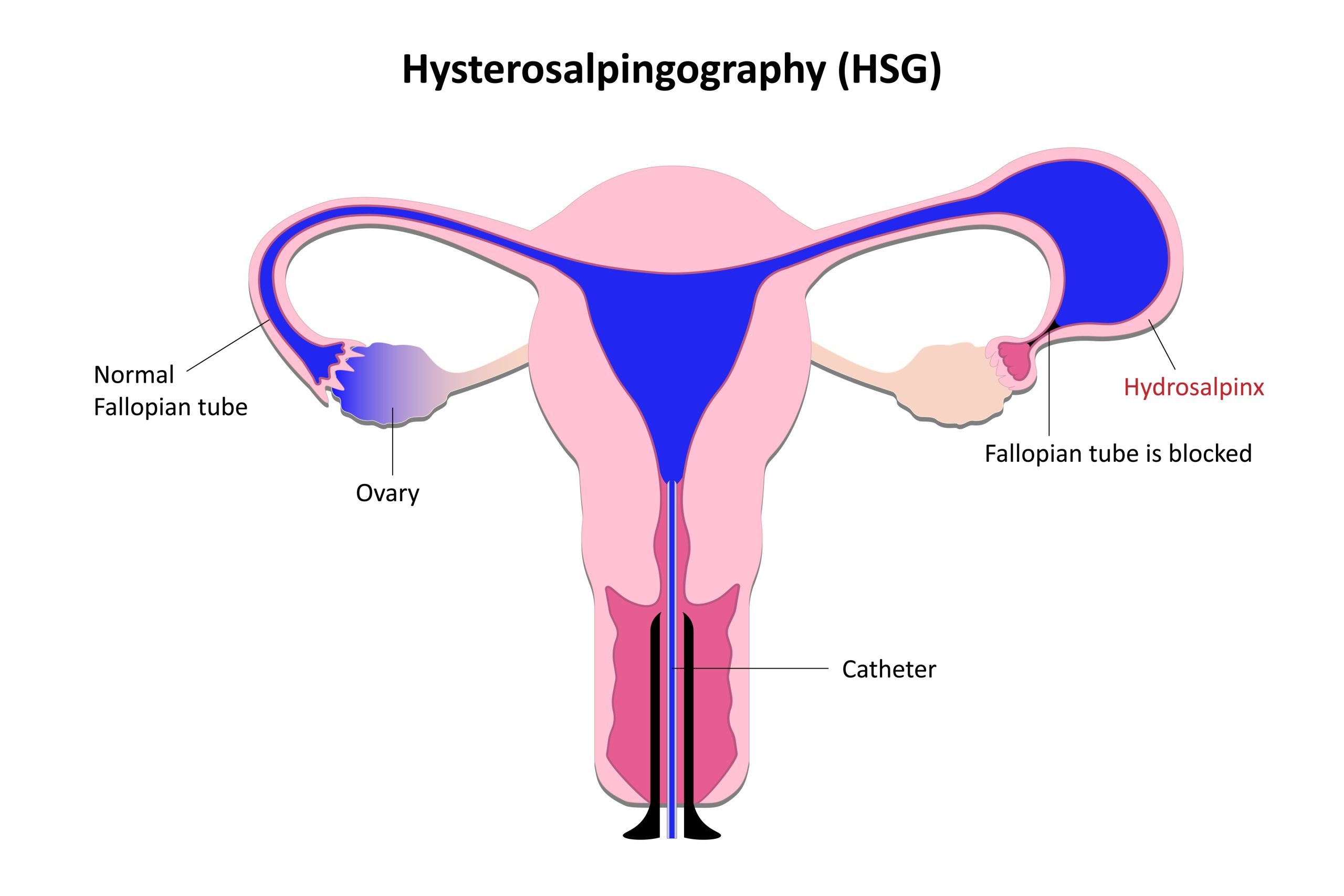 What is a Hysterosalpingogram (HSG)? Uses and Benefits