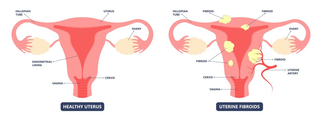 image of normal uterus next to image of uterus with fibroids 