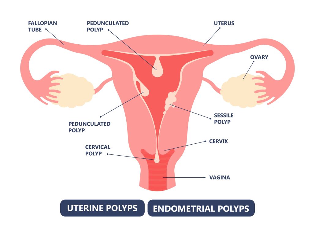 image of womb with uterine and endometrial polyps