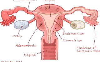 Adenomyosis and Infertility: Everything You Need to Know