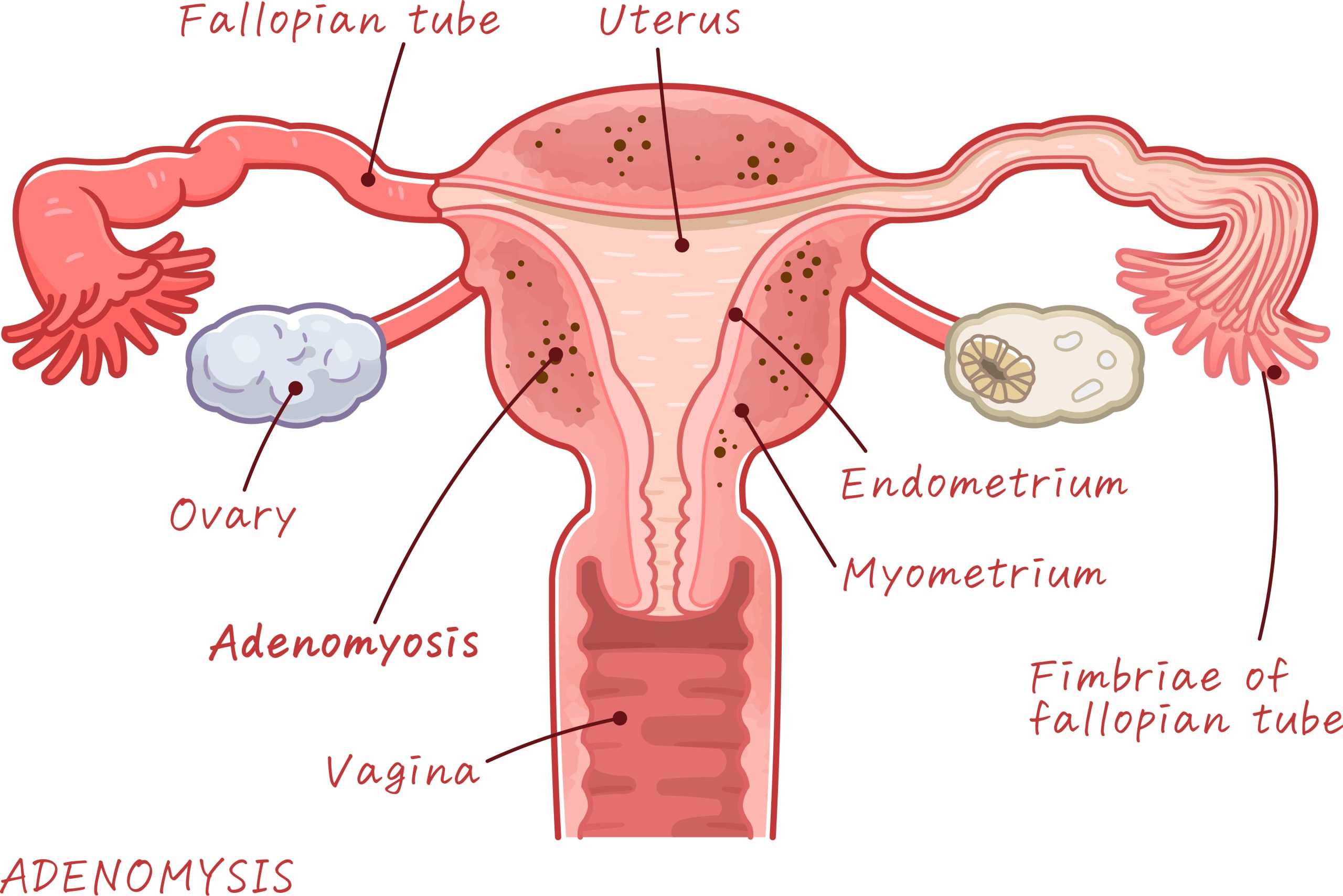 Adenomyosis and Infertility: Everything You Need to Know