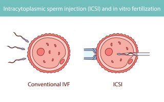 ICSI vs. IVF: What’s the Difference?