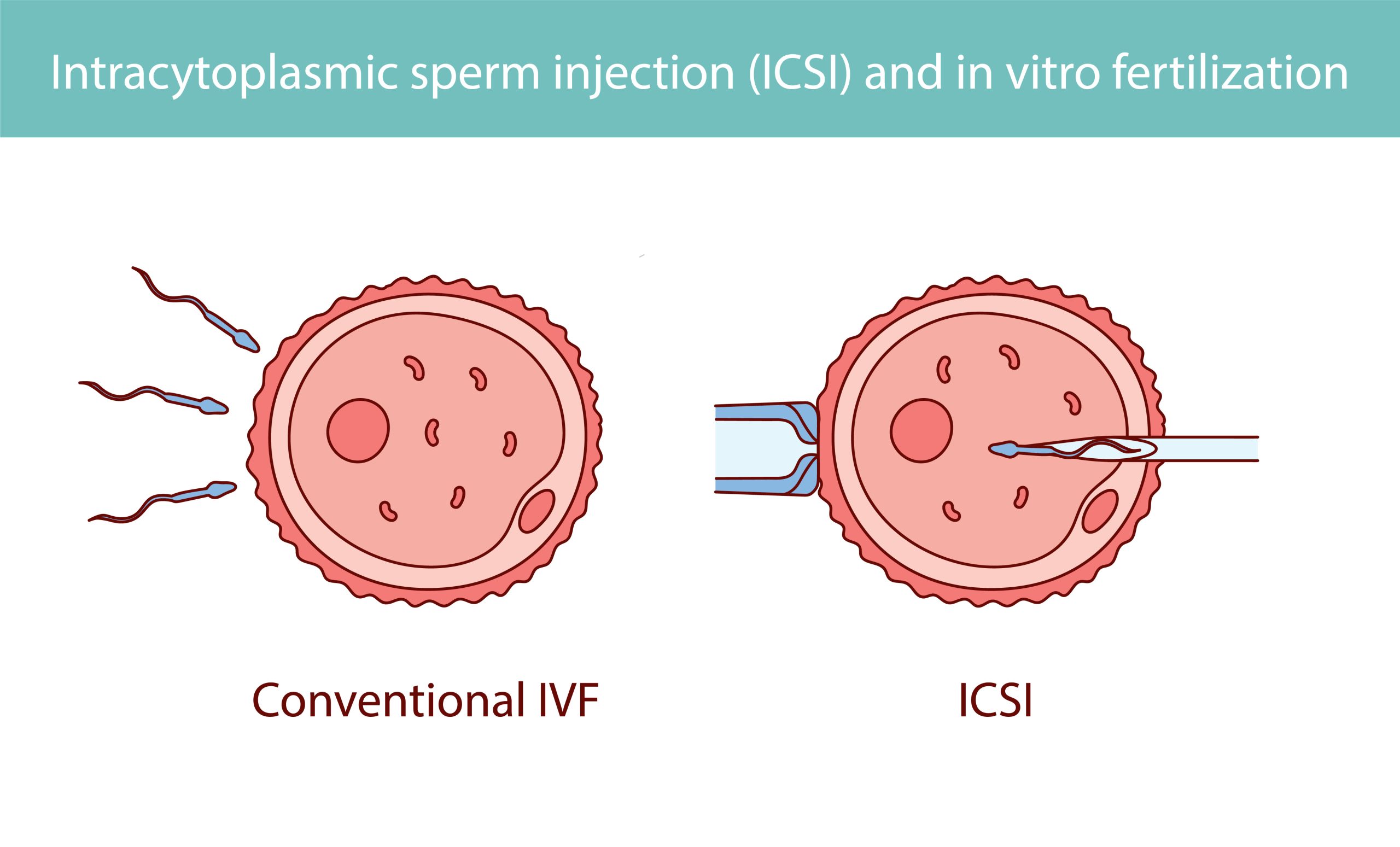 ICSI Vs. IVF: What's the Difference?