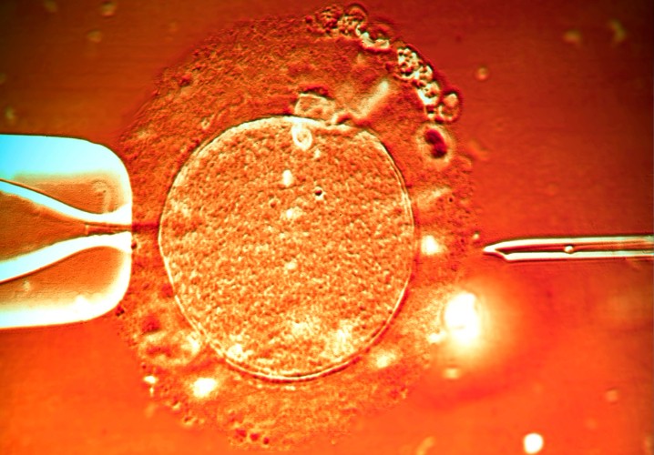 IVF After Tubal Ligation