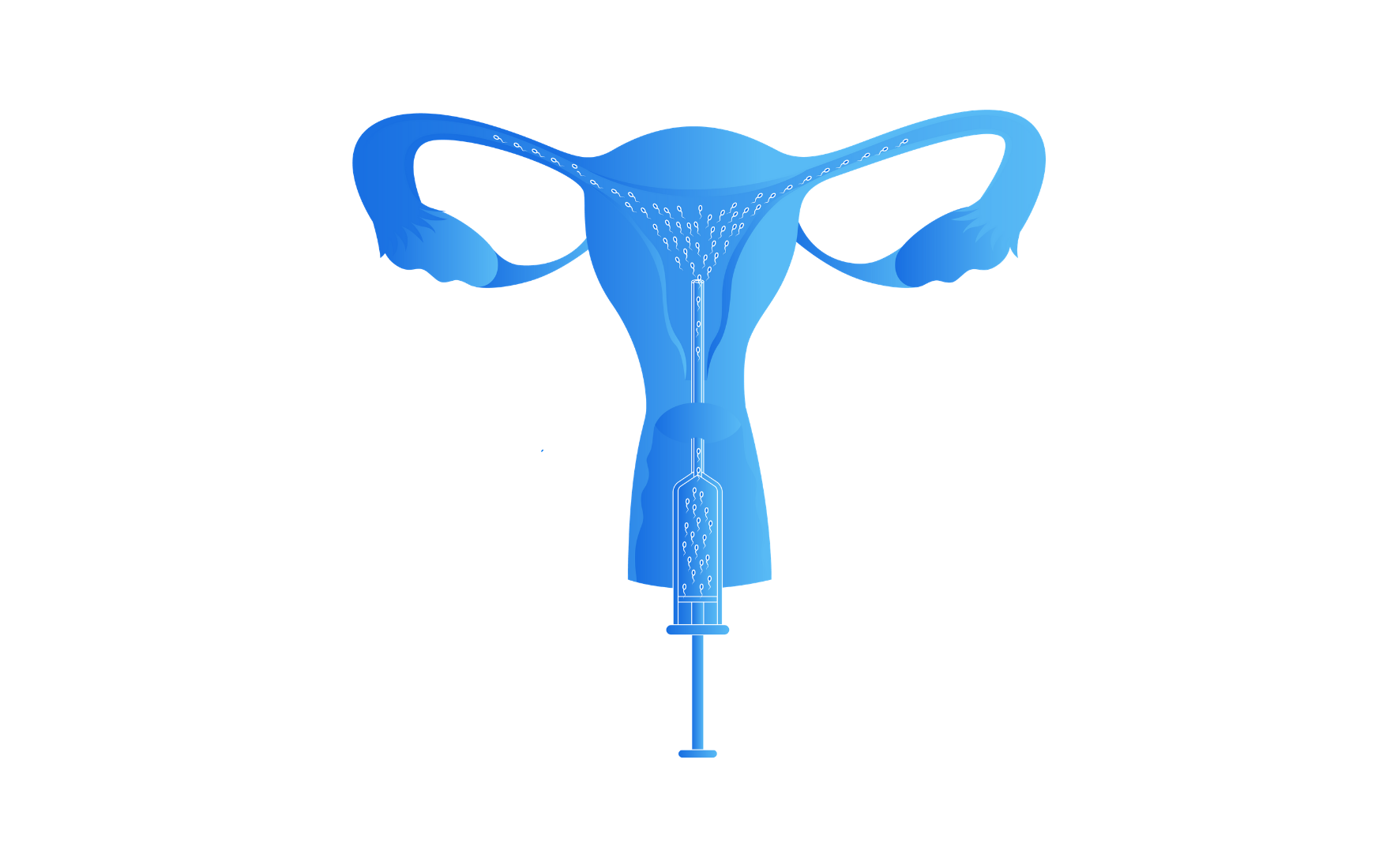 Artificial Insemination: Types, Process, Costs and more