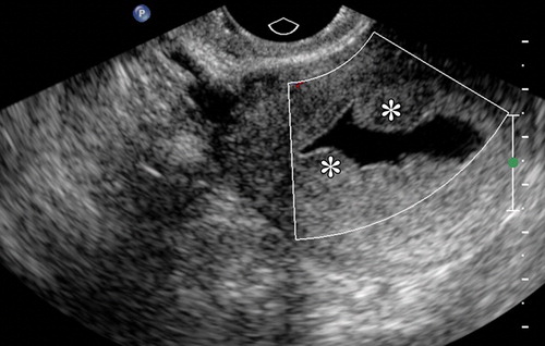 What is a Saline Infusion Sonohysterogram (SHG)? Everything You Need to Know